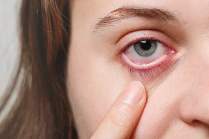 Get Rid of Red Eyes Without Eye Drops